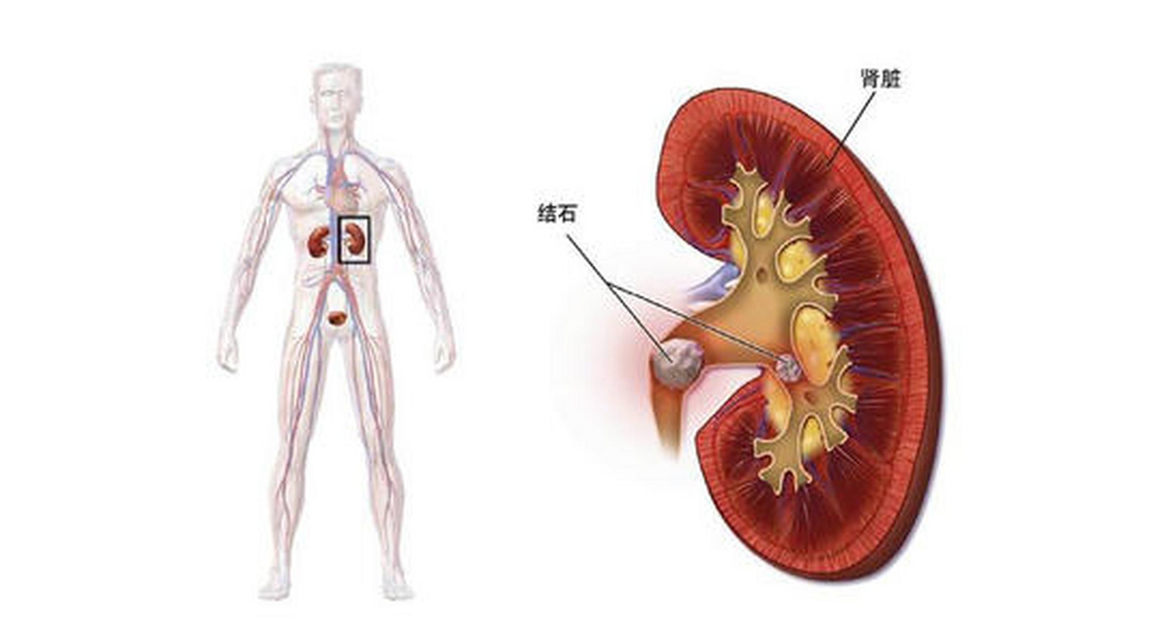 肾结石吃什么药好(04cm肾结石吃什么药好)