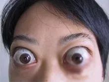 大脖子病吃什么(大脖子病吃什么中药)