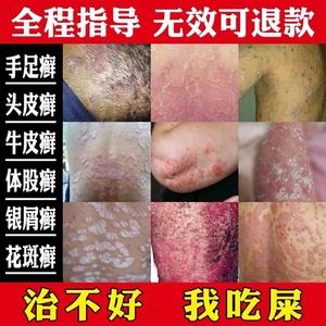 阴囊湿疹吃什么药(阴囊湿疹吃什么药好的快)